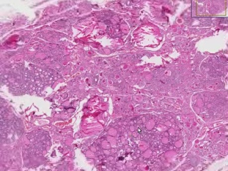 Nodular goiter