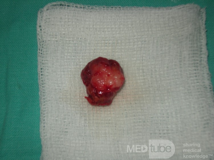 Parotid Gland Adenoma 