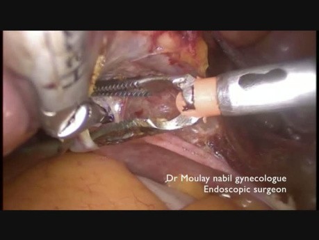 Total Laparoscopic Hysterectomy for Beginners