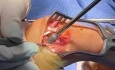When Surgery Doesn't Go as Planned - Rheumatoid Arthritis & PIP Fusion