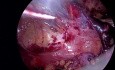Laparoscopic TEP Treatment of Right Inguinal Hernia