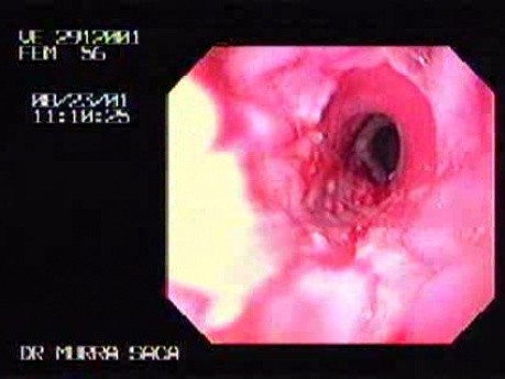 Reflux Esophagitis & Esophageal Stricture - Hiatal Hernia