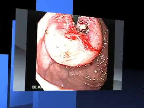 Gastrointestinal endoscopies of different stomach cancer