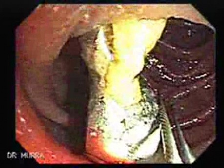 Dental Prothesis Found in the Jejuno (2 of 9)