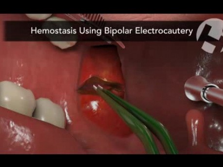 Tonsillo-Pharyngectomy