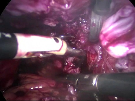 Treatment for Severe Endometriosis - Total Hysterectomy by Laparoscopic Method