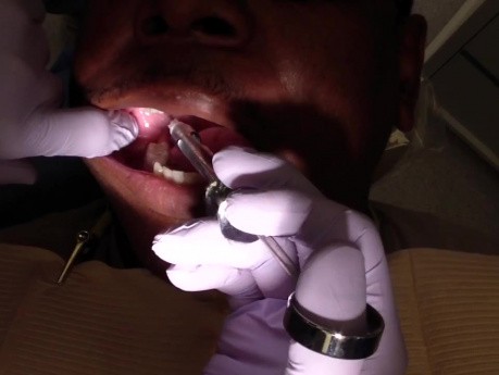 Inferior Alveolar Nerve Block - First Video Attempt