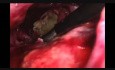 Laparoscopic Pancreatic Necrosectomy