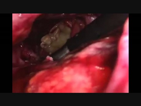 Laparoscopic Pancreatic Necrosectomy