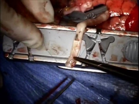 Coronary Bypass Surgery on an inoperable patient with Porcelain Aorta