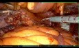 Robot-Assisted Pelvic Lymphadenectomy in Biochemical Relapse