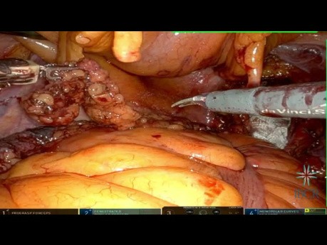 Robot-Assisted Pelvic Lymphadenectomy in Biochemical Relapse