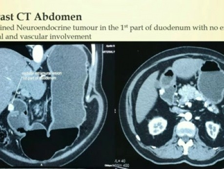 Laparoscopic Trans Duodenal Resection of Duodenal NeuroEndocrine Tumour