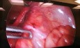 Laparoscopy for Strangulated Bowel Loop in the Uterine Broad Ligament
