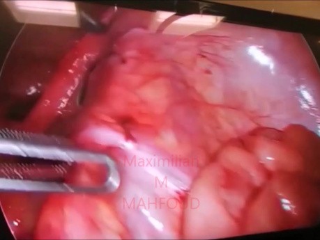 Laparoscopy for Strangulated Bowel Loop in the Uterine Broad Ligament