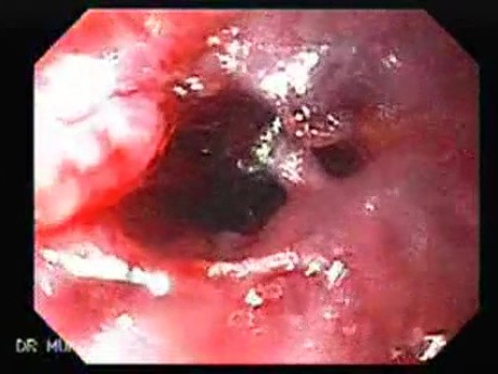 Perforation of a Esophageal Carcinoma after the procedure with hydrostatic balloon dilation (3 of 12)