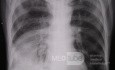 Lobar pneumonia 