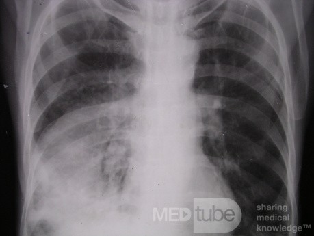 Lobar pneumonia 