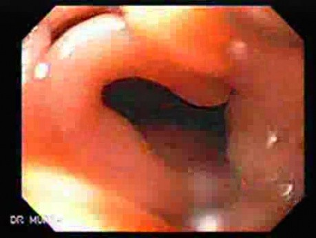Recurrent Gastric Cancer after Gastrectomy Billroth II (2 of 6)