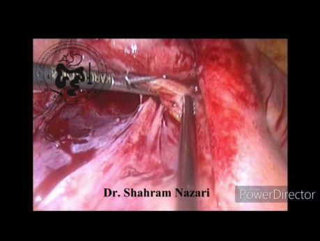 Laparoscopy in Acute Suppurative Appendicitis