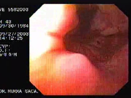 Acute Variceal Bleeding - Ligation of Eight Varices