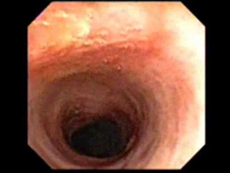 Endoscopy Through PEG - Dilated Part Of The Esophagus