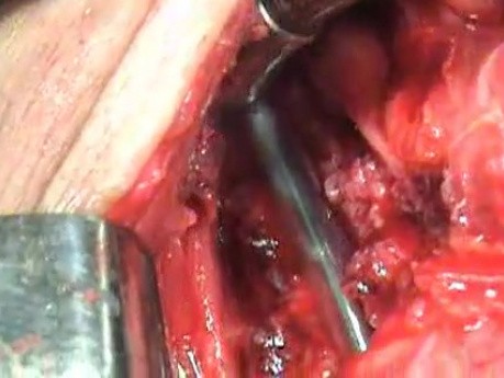 Perforation of a Esophageal Carcinoma after the procedure with hydrostatic balloon dilation (7 of 12)