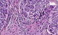 Bladder - Urothelial Carcinoma Grade I