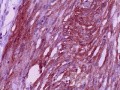 Jejunal Gastrointestinal Stromal tumor (GIST) (14 of 86)