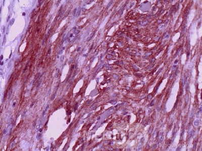 Jejunal Gastrointestinal Stromal tumor (GIST) (14 of 86)