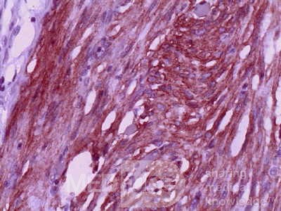 Jejunal Gastrointestinal Stromal tumor (GIST) (14 of 86)