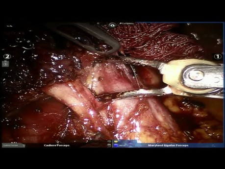 Middle Lobe Cancer Treated with Robotic Surgery