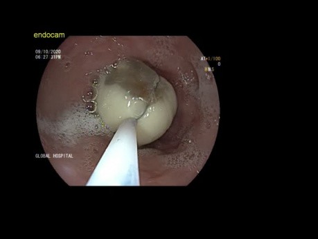 Endoscopic Treatment of Garlic Ingestion