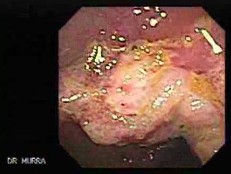 Cap polyposis that resemble a adenocarcinoma of the rectum (2 of 7)