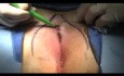 Bascom Cleft Lift Video - Pilonidal Surgery (Long)