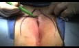 Bascom Cleft Lift Video - Pilonidal Surgery (Long)