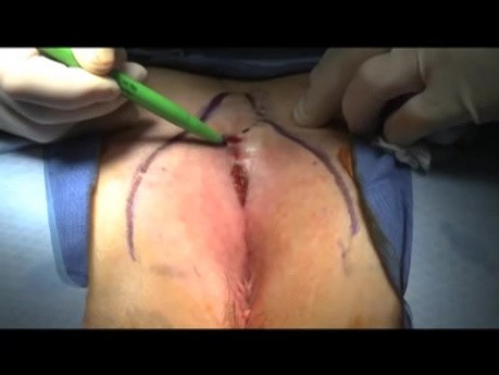 Bascom Cleft Lift Video - Pilonidal Surgery (Long)