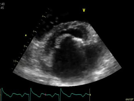 Stenosis of Mitral Valve caused by Rheumatic Heart Disease