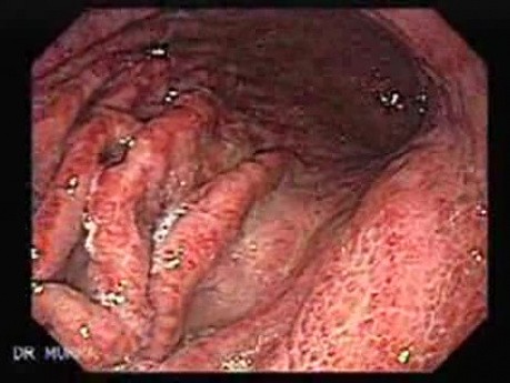 Acute Gastritis (3 of 4)