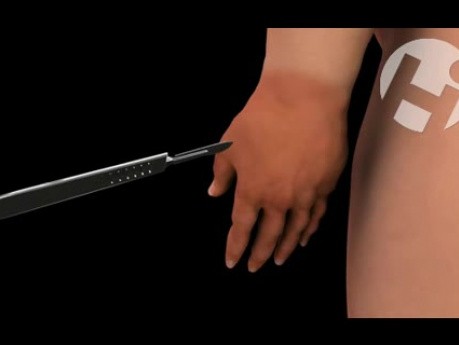 Treatment of Necrotizing Fasciitis