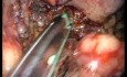 Laparo-Endoscopic Single Site (LESS) Distal Pancreatectomy and Splenectomy