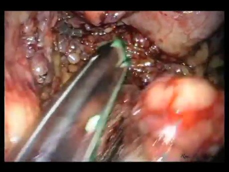 Laparo-Endoscopic Single Site (LESS) Distal Pancreatectomy and Splenectomy
