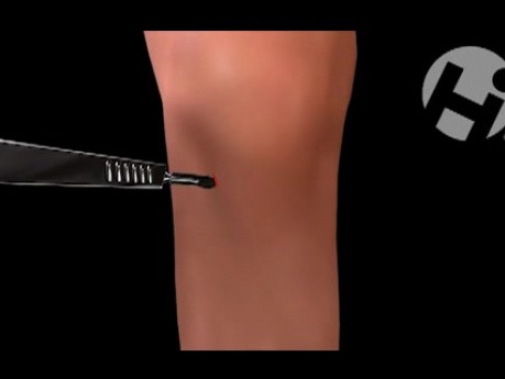 Knee Menisectomy