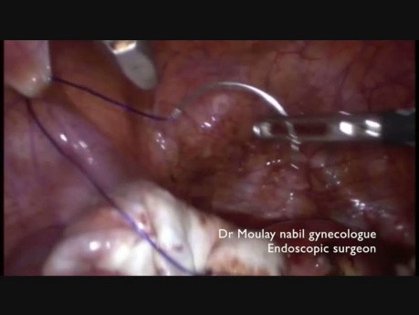 Laparoscopy for Hug Bilateral Ovarian Endometrioma 