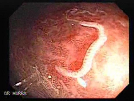 Schistosoma Mansoni (7 of 9)