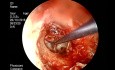 Endoscopic PORP Ossiculoplasty Tympanoplasty