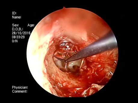 Endoscopic PORP Ossiculoplasty Tympanoplasty