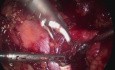 Laparoscopic Lymph Node Dissection for Prostatic Cancer Recurrence