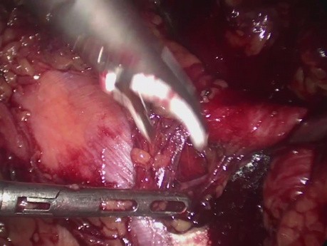 Laparoscopic Lymph Node Dissection for Prostatic Cancer Recurrence