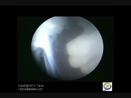 Embryoscopy 